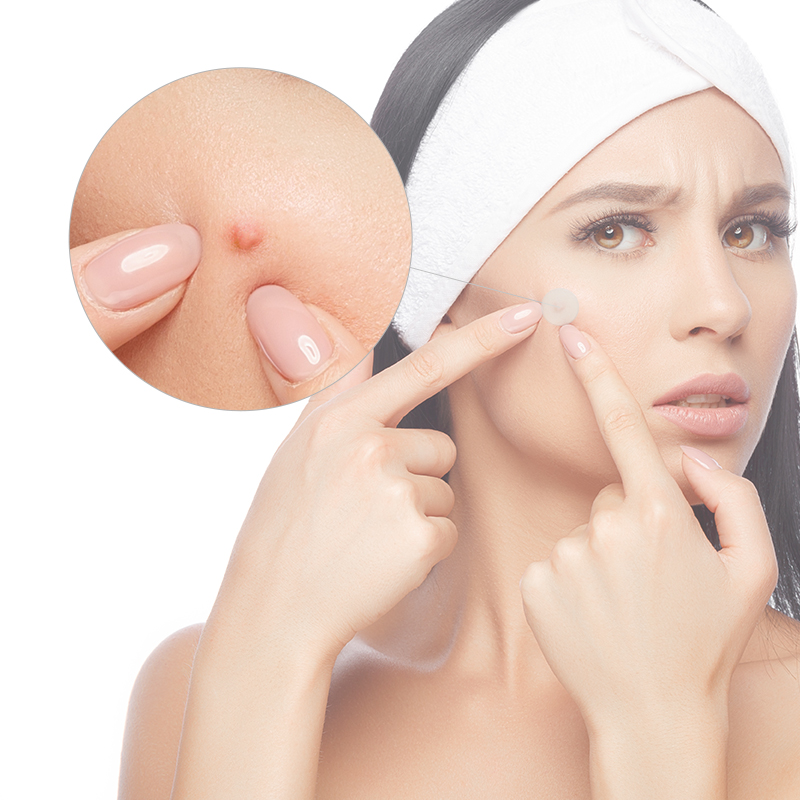 Parche para el acné