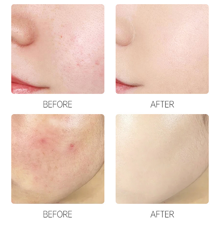 Parche para el acné